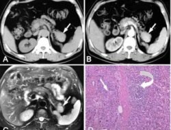 Accessory spleens Understanding Their Role and Impact